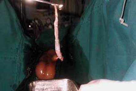 Hình ảnh một con cá Candiru được bác sỹ phẫu thuật lấy ra từ bộ phận sinh dục của nạn nhân. 