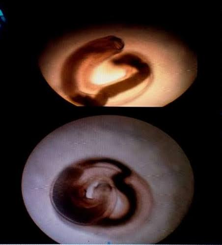 nhiễm ký sinh trùng